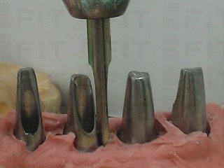 Cement Type 鈦材質客製化支台齒