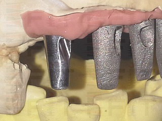 客製化CAD/CAM支台齒和鑄造支台齒的比較