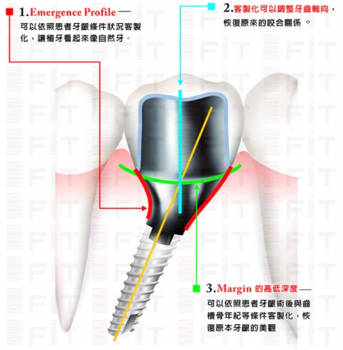 FIT CAD/CAM 客製化支台齒